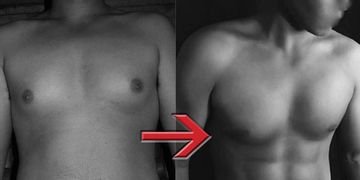 Liposucción de Alta Definición Hi-Def 4D Liposucción de Alta Definición Hi-Def 4D