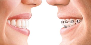 Invisalign, un motivo más para sonreir