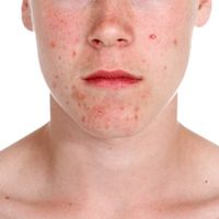 Fototerapia, un tratamiento que dice adiós al acné