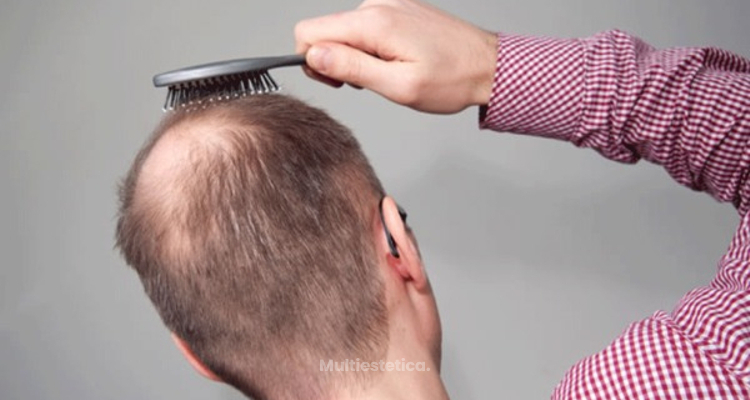 ¿Cómo detectar la alopecia precoz?