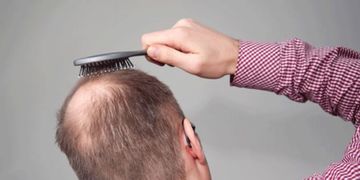¿Cómo detectar la alopecia precoz?