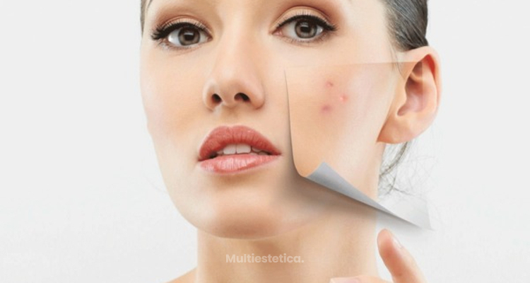 ¿Cómo deshacerte de manchas y cicatrices de acné?