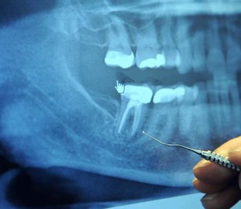 ¿Cuándo hay que someterse a una cirugía maxilofacial?