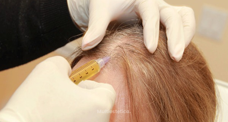 ​PRP como tratamiento contra la alopecia