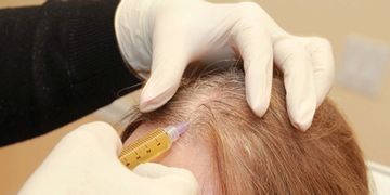 ​PRP como tratamiento contra la alopecia