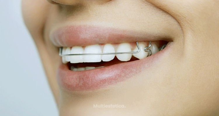 ​¿Qué aparato elegir para mejorar tu dentadura?