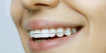 ​¿Qué aparato elegir para mejorar tu dentadura?