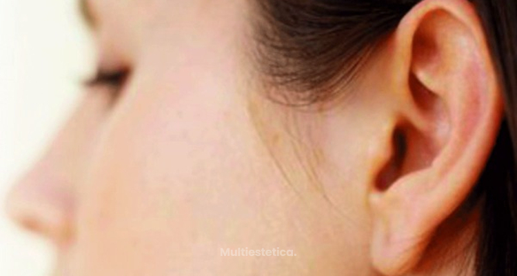 ​¿Es posible reconstruir el lóbulo de la oreja?