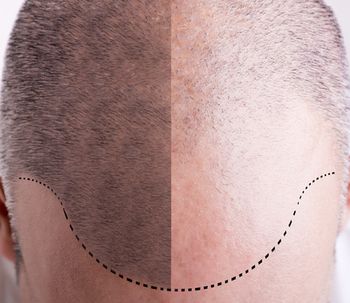 Un aliado óptico para la pérdida de cabello