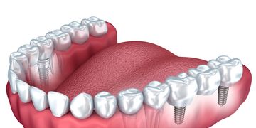 Ventajas de la prótesis dental fija de zirconia