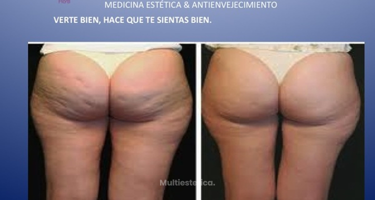 Los grados de la celulitis