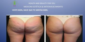 Los grados de la celulitis