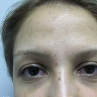 Lifting Frontal: Rejuvenecimiento facial (Primera Parte)