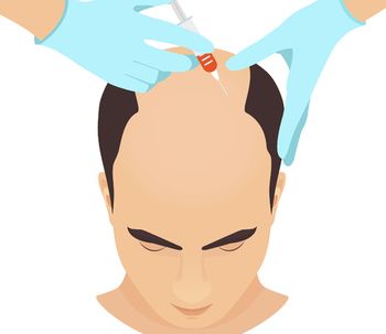 Bioestimulación capilar contra la alopecia