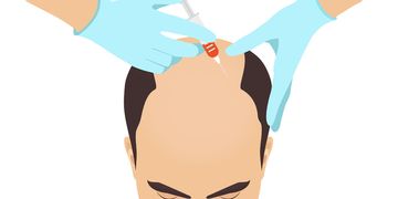 ​Bioestimulación capilar contra la alopecia