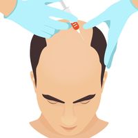 ​Bioestimulación capilar contra la alopecia