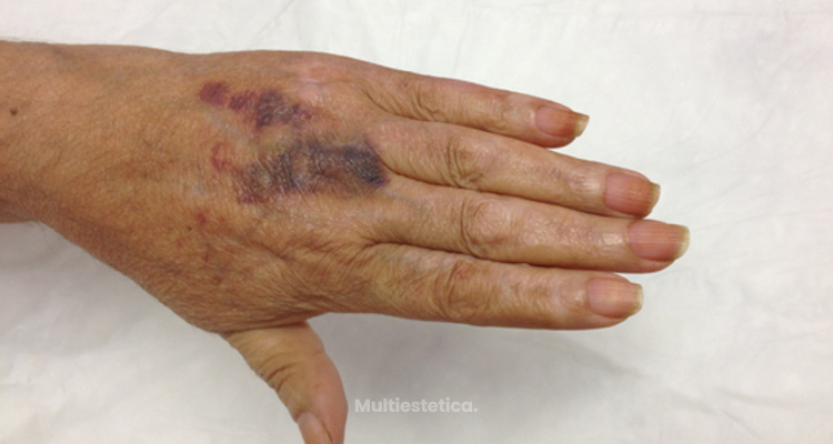 Dermatología y Vitiligo