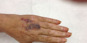 Dermatología y Vitiligo