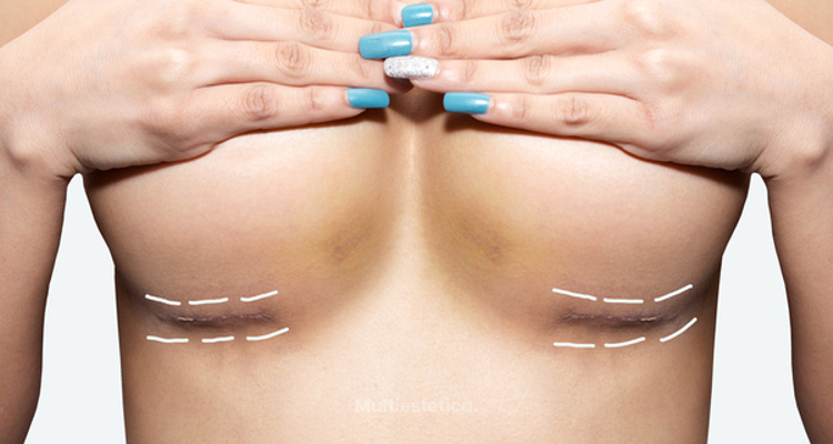 ​Tipos de cicatriz tras una cirugía de aumento de senos y cuidados