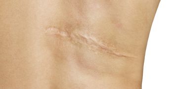 ​¿Cómo tratar una cicatriz queloide?