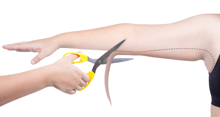 ​¿La liposucción de brazo es tan efectiva como la braquioplastia?