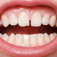​Soluciones a los dientes separados