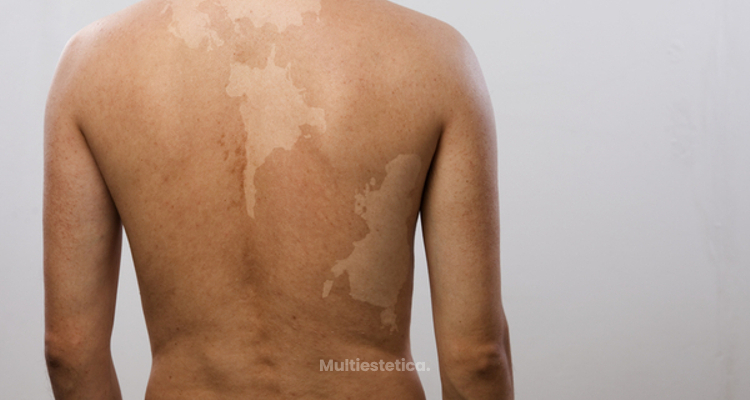 ​Detección y tratamientos para el vitiligo