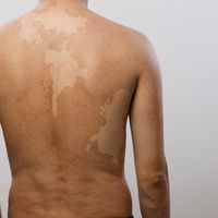 ​Detección y tratamientos para el vitiligo
