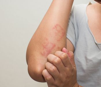 Tipos de psoriasis