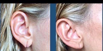¿Por qué ocurren los desgarros  en el lóbulo de la oreja?