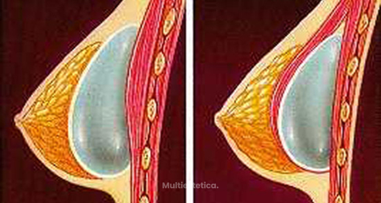 Implantes de seno, ¿Debajo o encima del músculo?