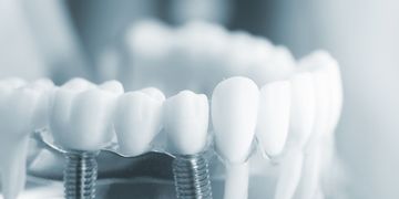​Implantes dentales de carga inmediata