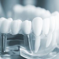 ​Implantes dentales de carga inmediata