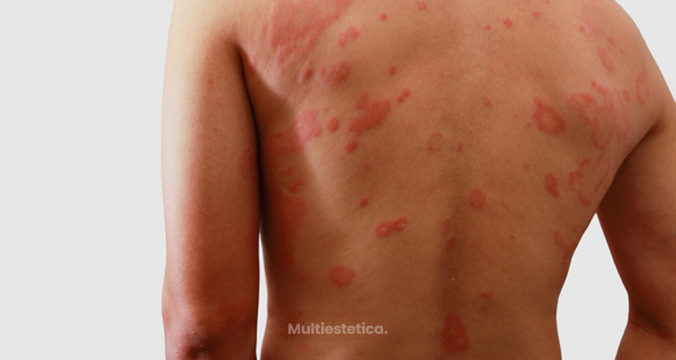 ​Conoce los tipos de dermatitis