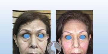 ¿Cómo lograr un verdadero rejuvenecimiento facial?
