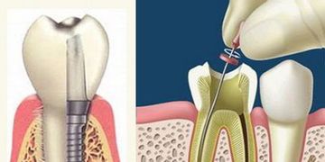 Extracción de dientes y endodoncia