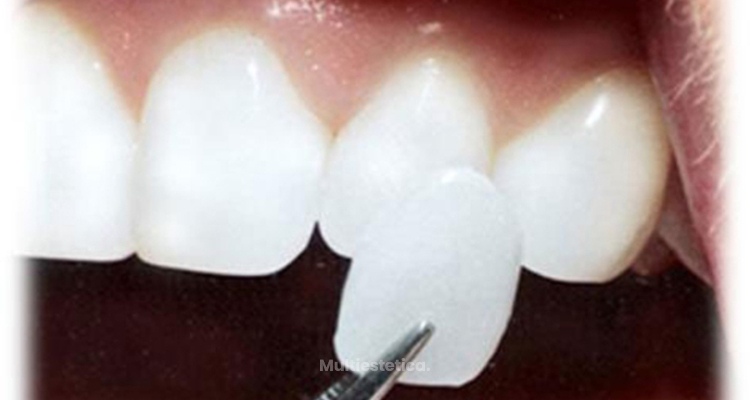 Carillas dentales, una opción discreta para mejorar tu sonrisa
