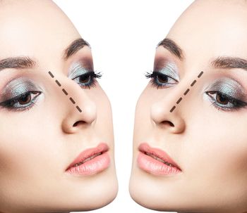 Rinoplastia mediante hilos tensores