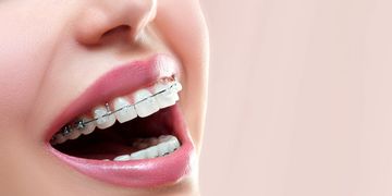 ​¿Cuáles son los tipos de ortodoncia?