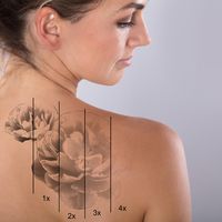 ​Láser y ablación de macrófagos; métodos seguros para eliminar tatuajes