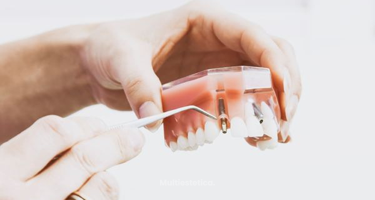 Implantes Dentales ¿Qué puntos debo conocer?