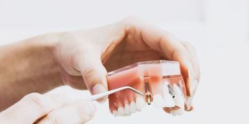 Implantes Dentales ¿Qué puntos debo conocer?