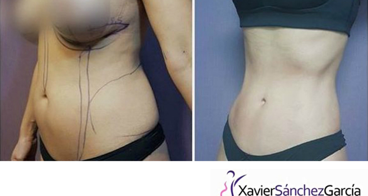 Lipectomía y/o abdominoplastia