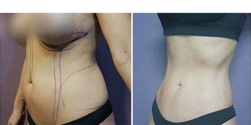 Lipectomía y/o abdominoplastia