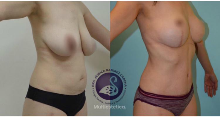¿Cómo saber si eres candidato a la abdominoplastia?