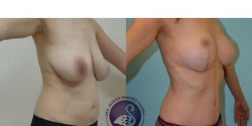 ¿Cómo saber si eres candidato a la abdominoplastia?