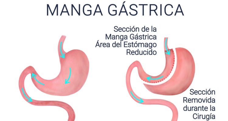 Todo sobre la manga gástrica - Multiestetica.mx