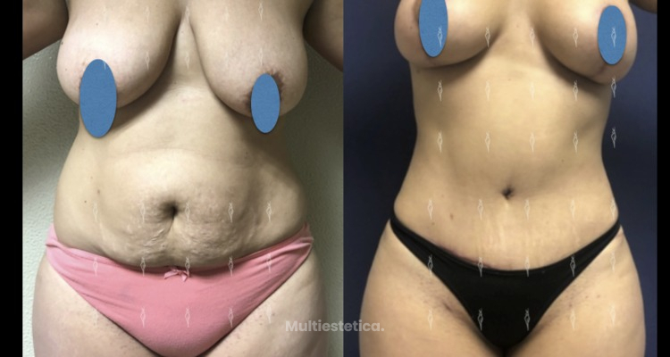 ¿Y tú sabes qué es el mommy makeover?