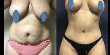 ¿Y tú sabes qué es el mommy makeover?