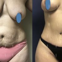 ¿Y tú sabes qué es el mommy makeover? ¿Y tú sabes qué es el mommy makeover?